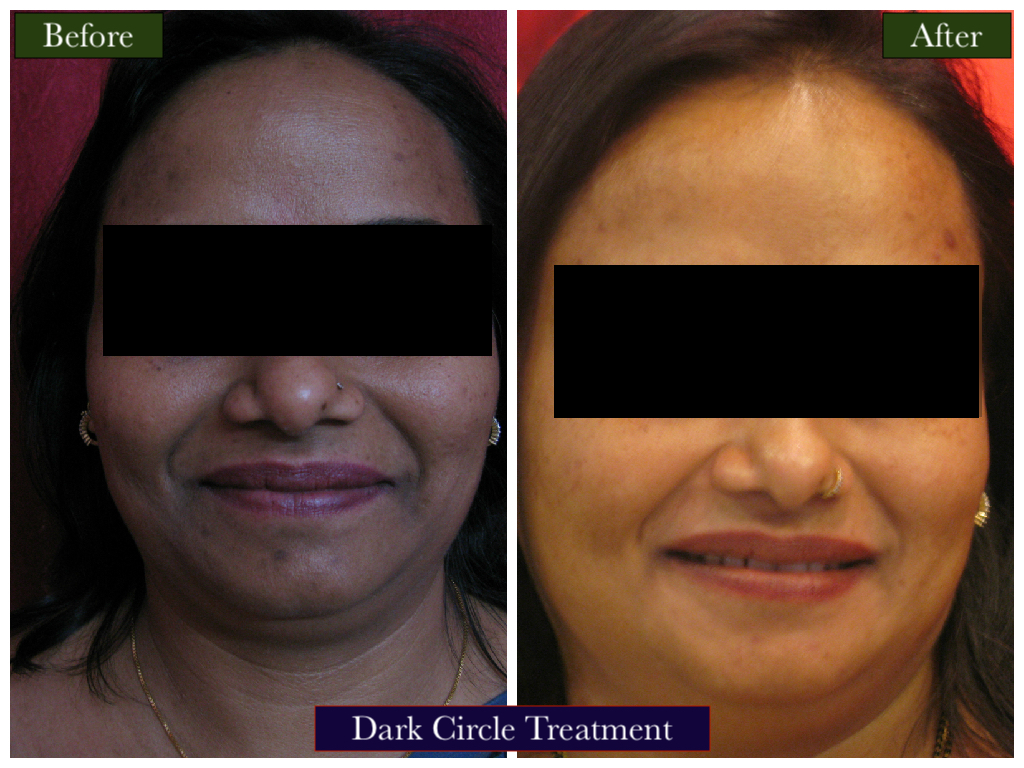 Dark Circle Treatment